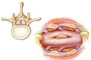 диастематомиелия