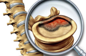 Лечение хондромиксоидной фибромы в Израиле