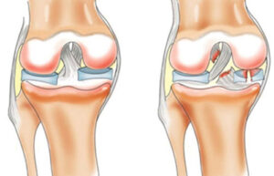 повреждение крестообразных связок коленного сустава
