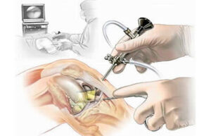 лечение повреждения крестообразных связок коленного сустава