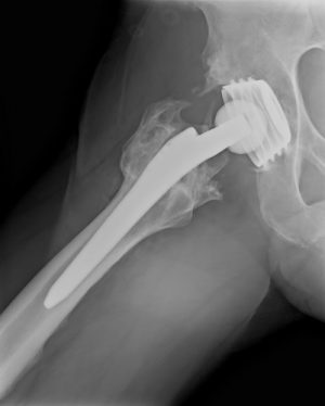 Как проводится замена суставов в Германии