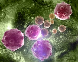 Лечение рака почки в Израиле