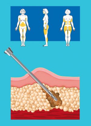 Современные виды липосакции и особенности ее проведения в Израиле