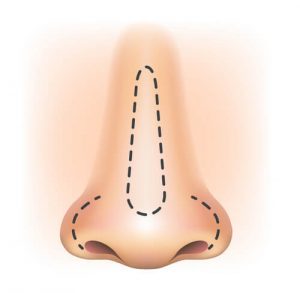 Как проводится ринопластика