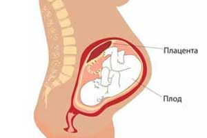 хориоангиома плаценты