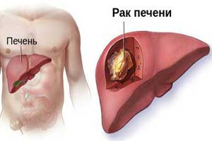 рак печени