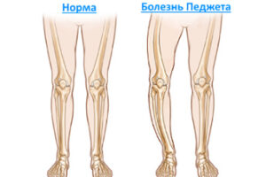 болезнь Педжета