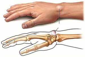 ганглионеврома
