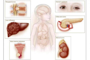 нейробластома