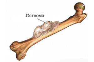 Остеома