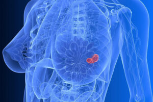 рак молочной железы