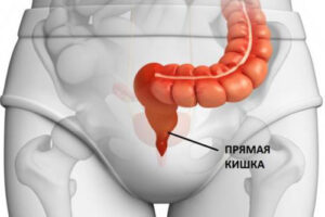 рак прямой кишки