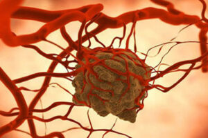 ангиосаркома