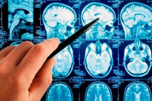 астроцитома