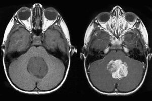 медуллобластома