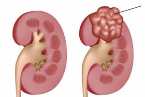нефробластома