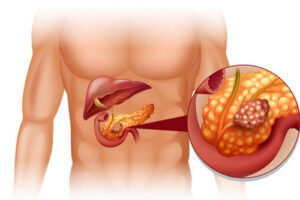 рак поджелудочной железы