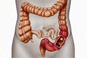 рак сигмовидной кишки