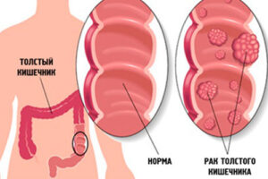 рак толстого кишечника