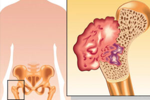 саркома кости