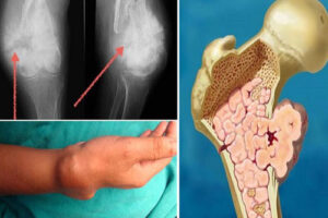 Саркома Юинга