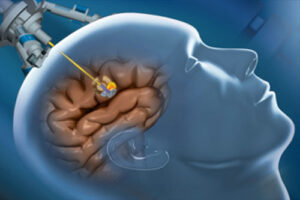 астроцитома