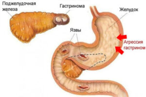 гастринома