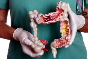 рак аппендикса