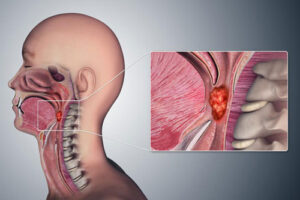 рак гортани