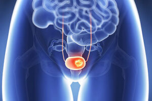 рак мочевого пузыря