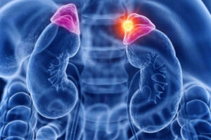 рак надпочечников