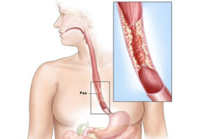 рак пищевода