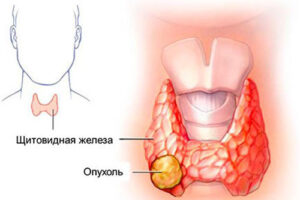 рак щитовидной железы