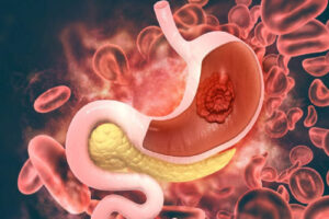 рак желудка