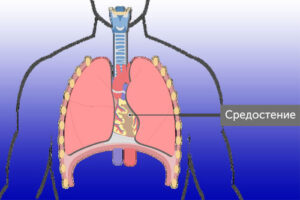 рак средостения