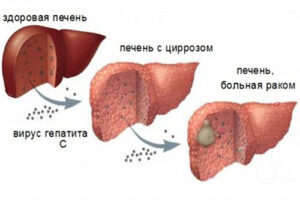 гепатоцеллюлярная карцинома