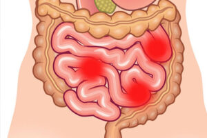 рак тонкого кишечника