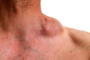 лимфома Беркитта