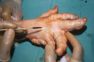 болезнь Олье