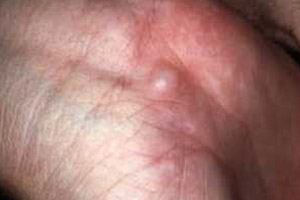 неврилеммома