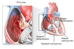 фиброма сердца