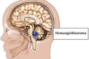 гемангиобластома
