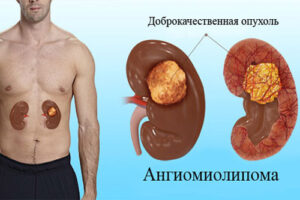 ангиомиолипома