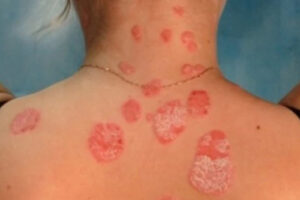 грибовидный микоз