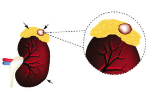 альдостерома