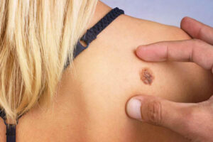 ангиосаркома