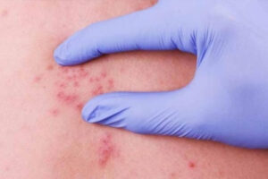 липосаркома