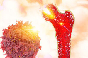 хондробластома