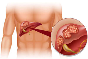 гепатобластома