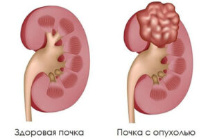 гипернефрома